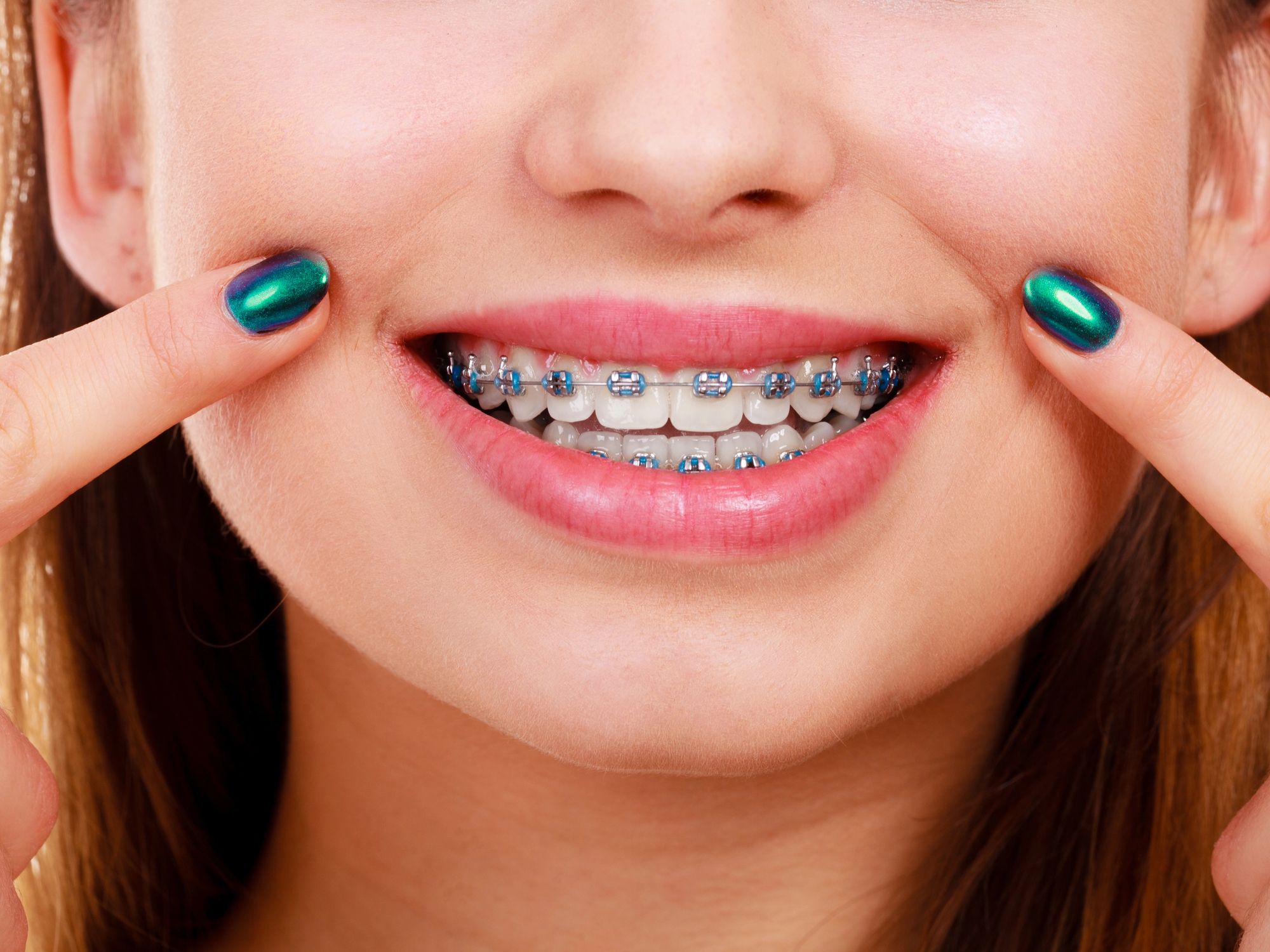 Braces
